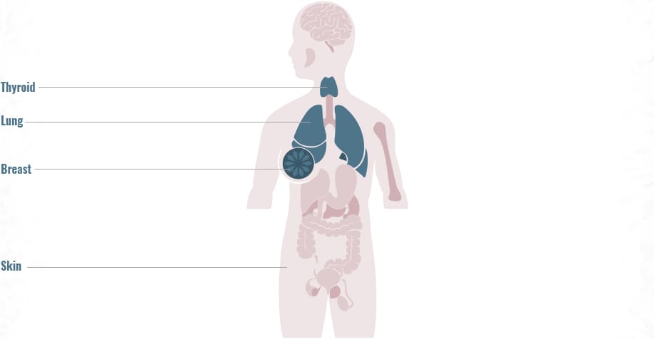 Distribution of RET gene fusions across primary tumor sites graphic
