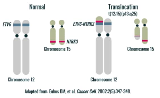 ETV6-NTRK3 gene fusion mechanism graphic ETV6-NTRK3 gene fusion mechanism graphic